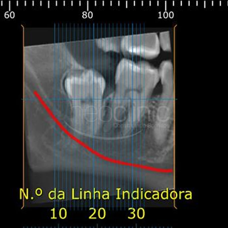 extracao-de-siso-em-florianopolis extracao-de-siso-em-florianopolis