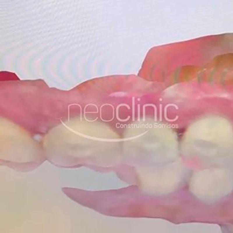 invisalign-pros-e-contras invisalign-pros-e-contras