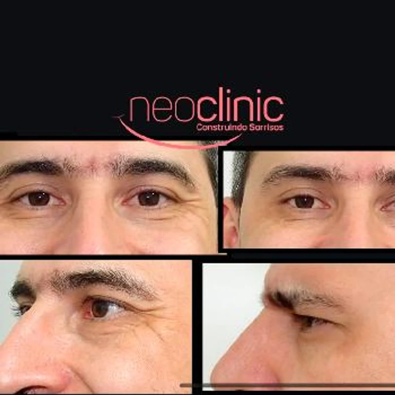 beneficios-do-botox-facial beneficios-do-botox-facial