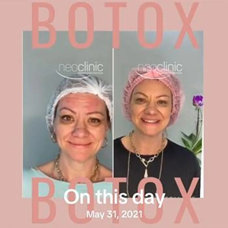 botox-full-face botox-full-face