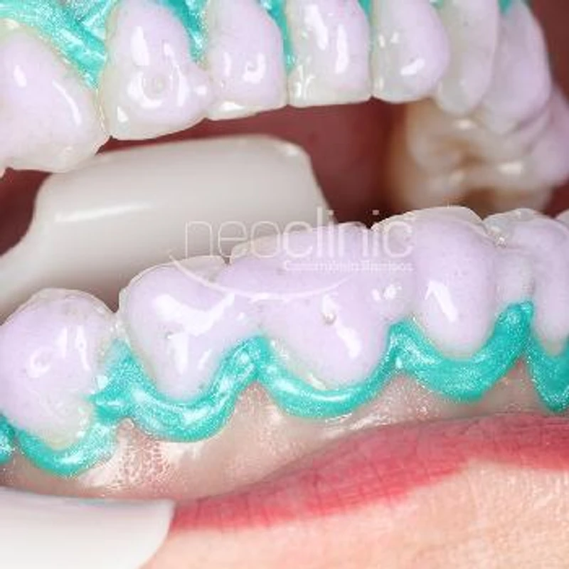 clareamento-dental-em-florianopolis clareamento-dental-em-florianopolis