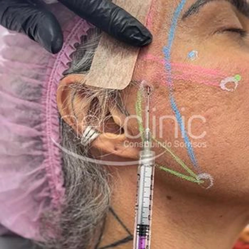 como-e-aplicado-o-bioestimulador-de-colageno como-e-aplicado-o-bioestimulador-de-colageno