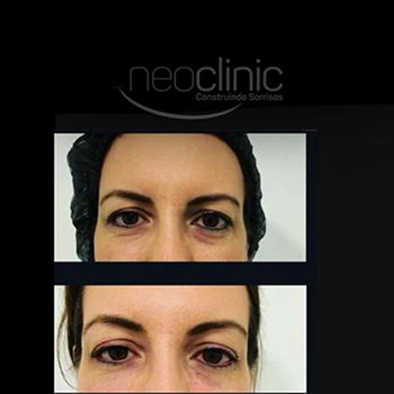 como-e-feito-preenchimento-facial