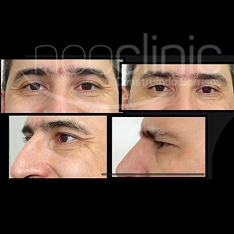 como-funciona-o-botox-facial como-funciona-o-botox-facial