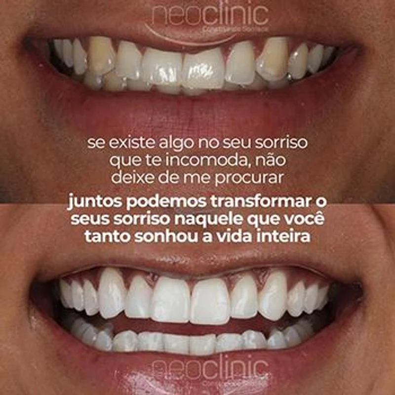 como-funciona-o-clareamento-dental como-funciona-o-clareamento-dental