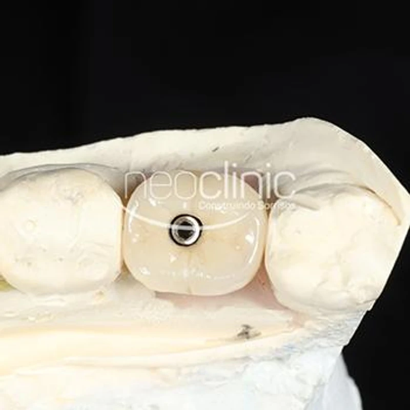implantes-dentarios implantes-dentarios