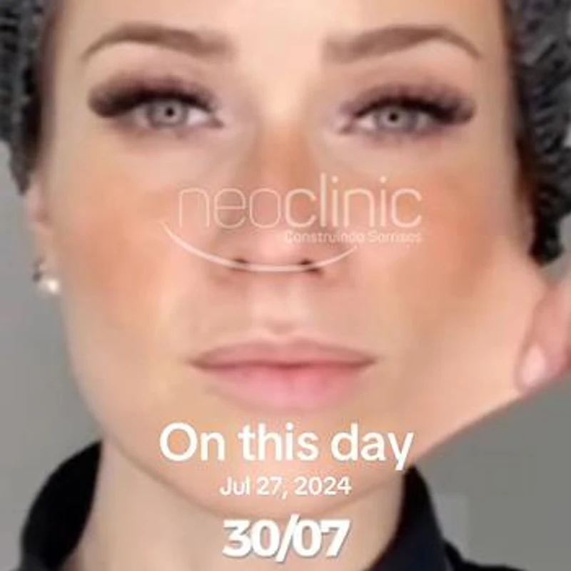 ultraformer-area-dos-olhos-antes-e-depois ultraformer-area-dos-olhos-antes-e-depois