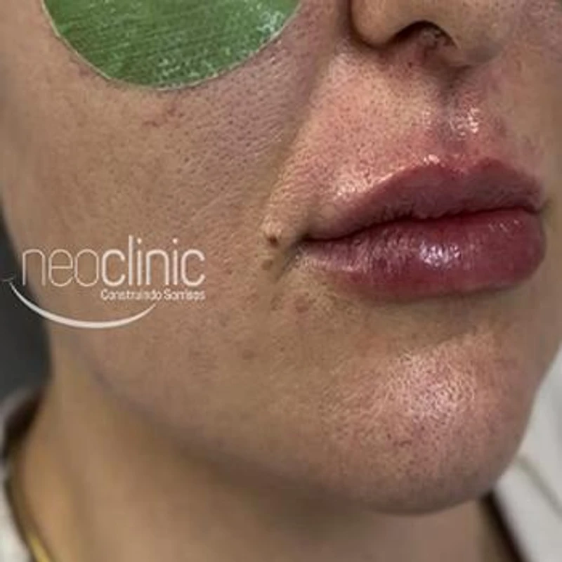preenchimento-facial-preco