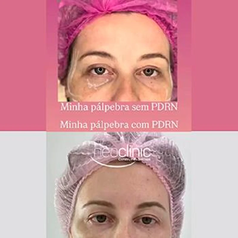 preenchimento-de-olheiras-com-acido-hialuronico preenchimento-de-olheiras-com-acido-hialuronico