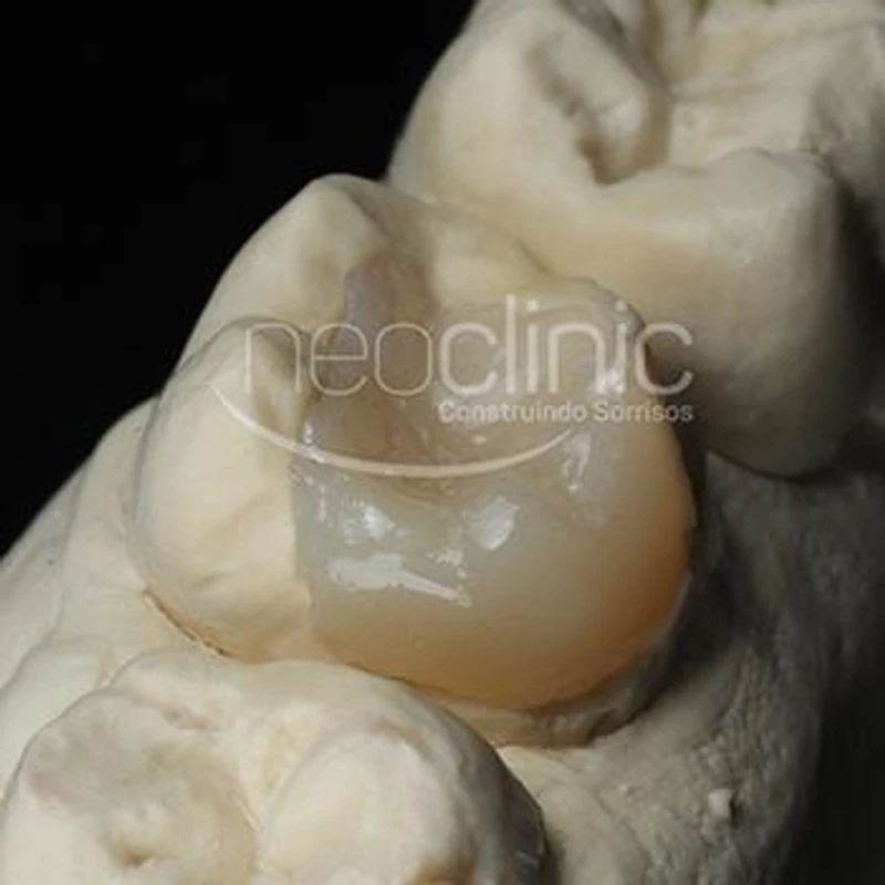 onlay-dental onlay-dental