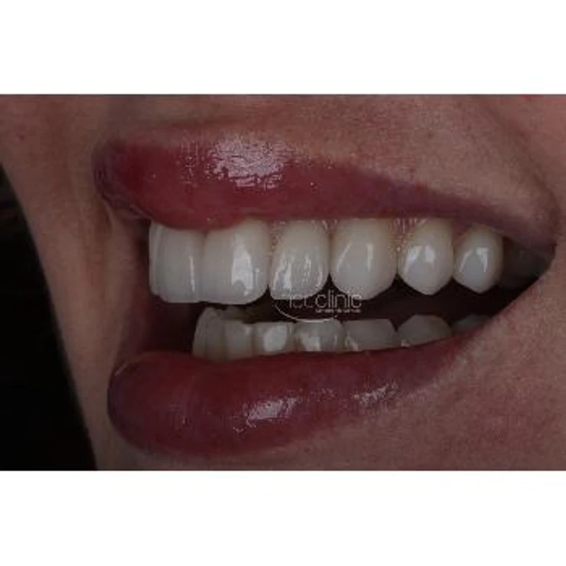 lente-de-contato-dental lente-de-contato-dental