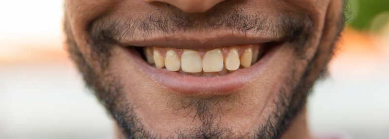 Dentes amarelos: o que fazer?