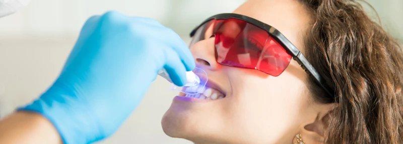 Clareamento dental caseiro ou no consultório?