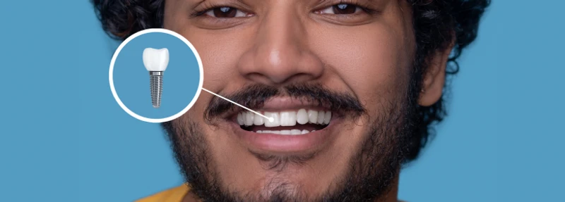 Implantes dentários: tudo o que você precisa saber